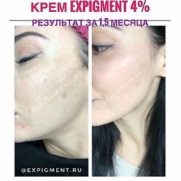 expigment реальные отзывы: Крем Expigment напрямую с Турции. В составе гидрохинон. доставка по — 2