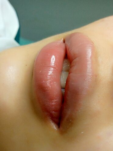 Косметология: Косметология, Биоревитализация, Ботулинотерапия, Контурное моделирование, Гипоаллергенные материалы, Консультация, Сертифицированный косметолог — 17