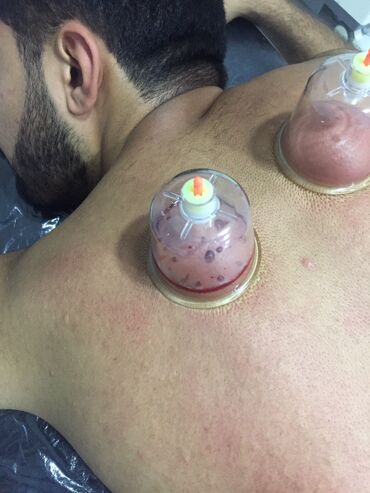 Hicama, zəli: Bəylər üçün = Hicama Və Zəli ✅Zəlinin Faydaları(Hirudoterapiya) — 7