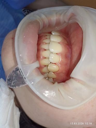 Ортезы: Ортодонтическое лечение: установка брекет‑системы на нижнюю челюсть - — 6