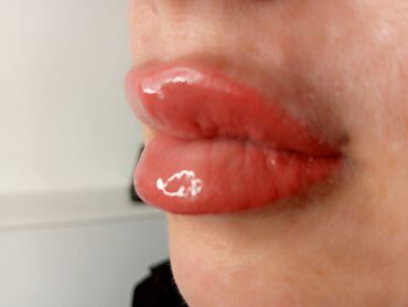 Косметология: Косметология, Биоревитализация, Ботулинотерапия, Контурное моделирование, Гипоаллергенные материалы, Консультация, Сертифицированный косметолог — 6