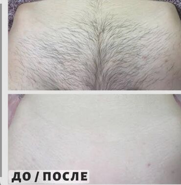 удаление татуажа лазером цена: Женский шугаринг!!! Стерильность и профессионализм! предварительная