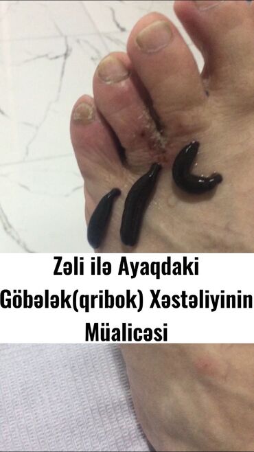 Hicama, zəli: Hicamanın Faydaları✅ *Qan dövranın pozulması *Qanın təmizlənməsi — 7