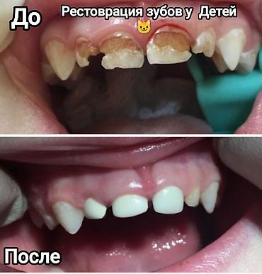 Стоматологи: Съёмные зубные протезы под ваши задачи - Вакуумные протезы: плотная — 11