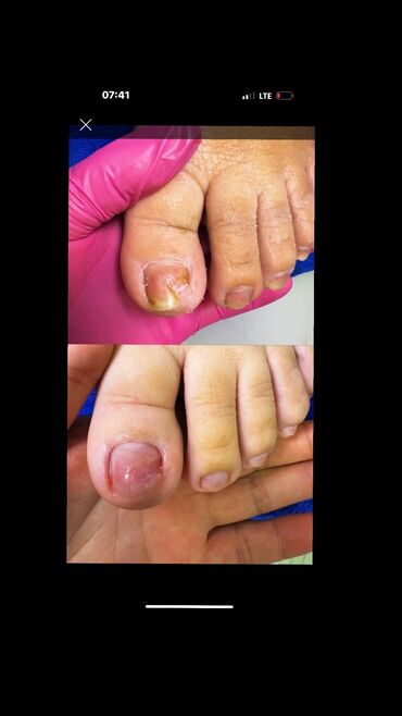 формы для садовых дорожек: Ичине кирип өскөн тырмактарды оңдоо, Подолог кызматтары, Бир жолку сарпталуучу материалдар