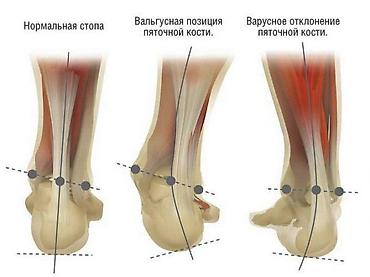Медтовары: Стельки ортопедические(специализированные) от плоскостопия! Для — 5