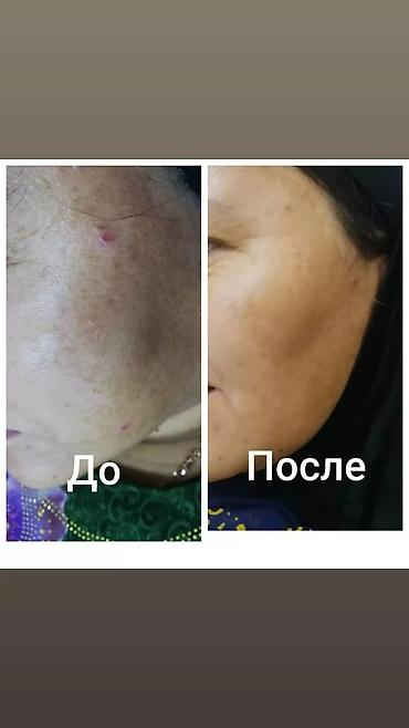 rf лифтинг: Косметология, Пилинг, Сертифицированный косметолог — 2