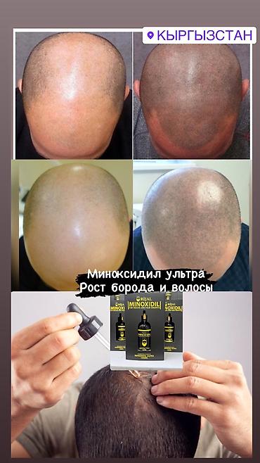 Уход за телом: Рост борода и волосы Миноксидил ультра 15% оригинал✅из Турции🇹🇷 — 9