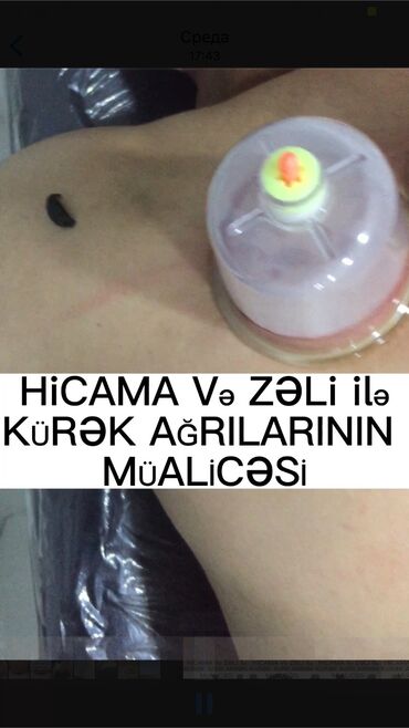 Kosmetologiya: Bəylər üçün = Lazer Epilasiyasi✅Hicama və — 12