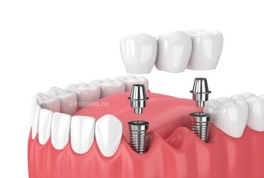 stomatologiya: Diş implantları, itirilmiş dişləri əvəz etmək üçün istifadə olunan