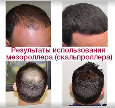 Уход за телом: Мезороллер разные размеры игл - прямые поставки - читаем текст смотрим — 6