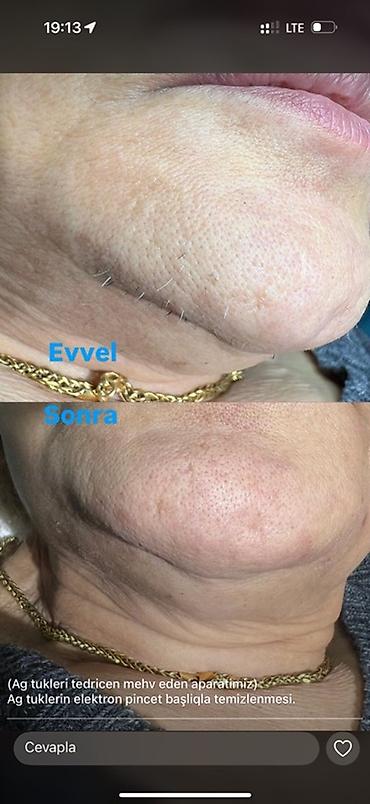 qapi: Xidmət: Ağ tüklərin elektron pincet başlıqla təmizlənməsi və tədricən — 1