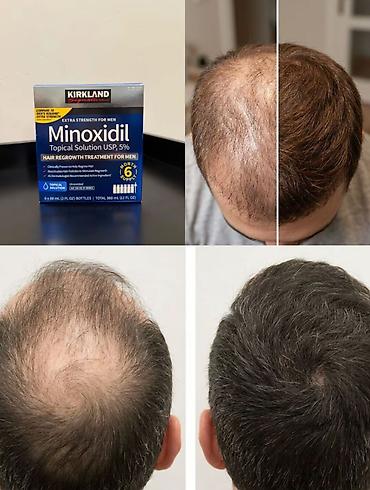 centrum vitamin: 🔥 Kirkland Minoxidil 5% (60 ml) — 💯 ABŞ-dan ORİJİNAL (Costco) 🚨 VACİB — 2