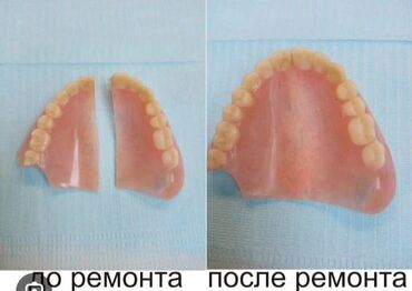 Paltar tikişi: Hər növ cixan protezlərin təmiri