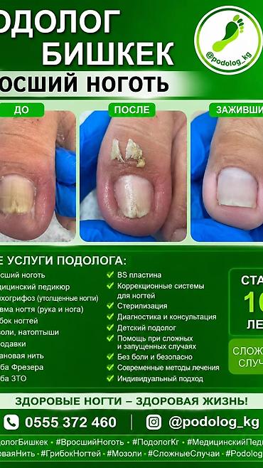 обувь ортопед: Коррекция вросших ногтей, Услуги подолога, Одноразовые расходные материалы — 2
