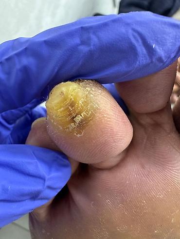 Маникюр: 📢акция с ! Вросший ноготь 📍подологический педикюр,👣 📍мозоли — 13