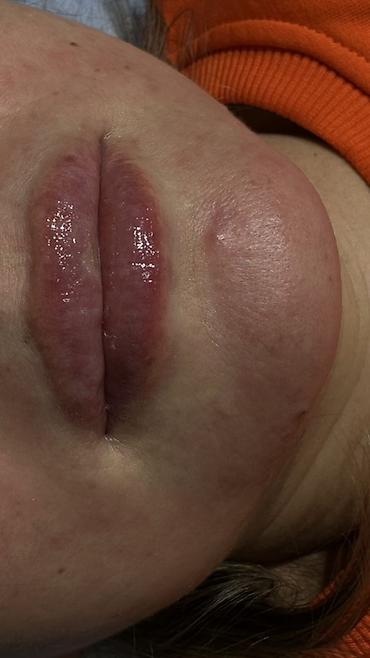 Косметология: Косметология, Увеличение губ, Гипоаллергенные материалы at lalafo.kg — 7 Косметология: Косметология, Увеличение губ, Гипоаллергенные материалы — 7