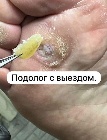 ногтевой набор: Коррекция вросших ногтей, Педикюр, Одноразовые расходные материалы — 1