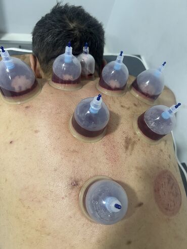 Hicama, zəli: Hicamanın Faydaları✅ *Qan dövranın pozulması *Qanın təmizlənməsi — 18