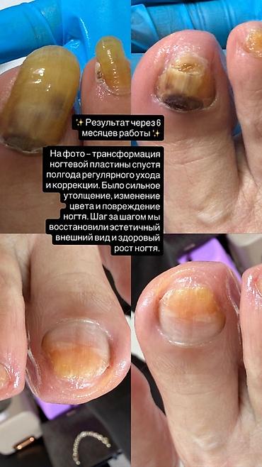 падолог: Коррекция вросших ногтей, Услуги подолога, Одноразовые расходные материалы — 1