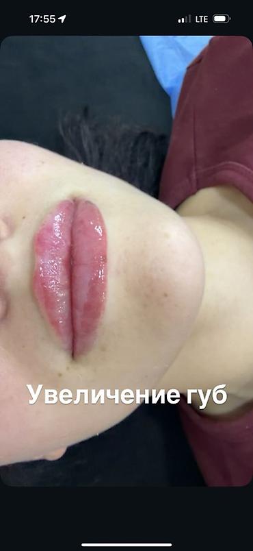 Косметология, Увеличение губ, Сертифицированный косметолог