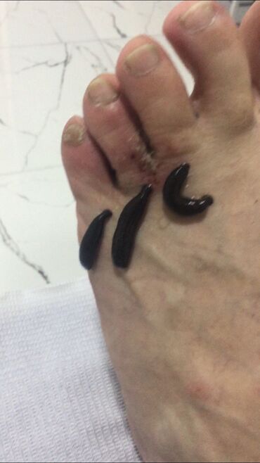 Hicama, zəli: Bəylər üçün = Hicama Və Zəli ✅Zəlinin Faydaları(Hirudoterapiya) — 12