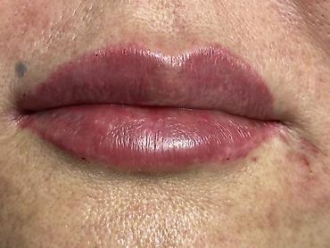 Косметология: Косметология, Увеличение губ, Гипоаллергенные материалы at lalafo.kg — 34 Косметология: Косметология, Увеличение губ, Гипоаллергенные материалы — 34