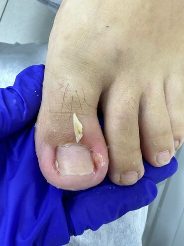 Маникюр, педикюр: Коррекция вросших ногтей, Маникюр, Педикюр, Услуги подолога, Консультация, Одноразовые расходные материалы — 7