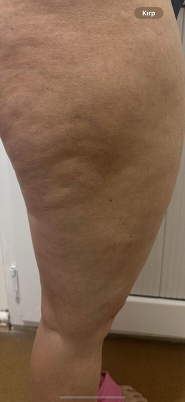 Masaj: Vakuum masajı, Qadınlar üçün — 2