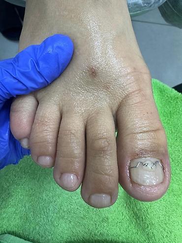 Маникюр: 📢акция с ! Вросший ноготь 📍подологический педикюр,👣 📍мозоли — 10