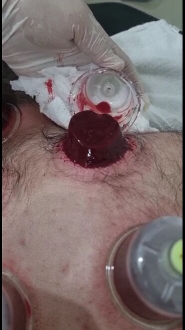 Hicama, zəli: Bəylər üçün = Hicama Və Zəli ✅Zəlinin Faydaları(Hirudoterapiya) — 14