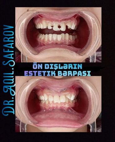 diş həkimi: Stomatologiya | Keramika, Diş daşlarının təmizlənməsi, Plomblanması | Kredit