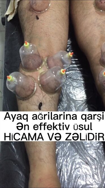 Hicama, zəli: Hicamanın Faydaları✅ *Qan dövranın pozulması *Qanın təmizlənməsi — 5