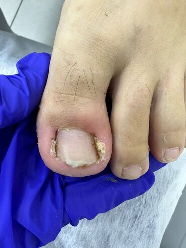 Маникюр, педикюр: Коррекция вросших ногтей, Маникюр, Педикюр, Услуги подолога, Консультация, Одноразовые расходные материалы — 6