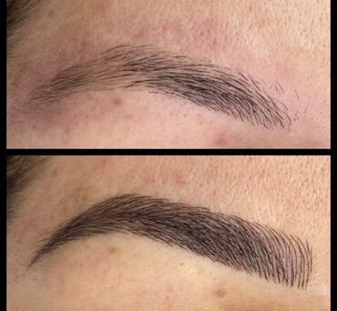 Kirpiklər, qaşlar: Seyrek formasiz qaslarin mikrobledinqle berpasi — 6