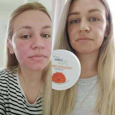 Nega kože: Limes Rosa Porodična krema – kantarion i neven Višenamenska krema za — 3