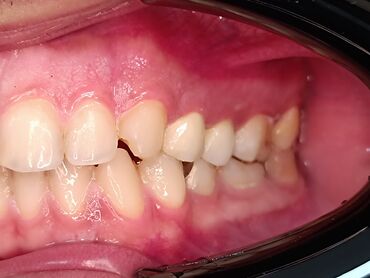 İşıqlandırma: Məhsul: Smartfon üçün diş həkimi çəkiliş seti – LED halqa işıqlı — 6