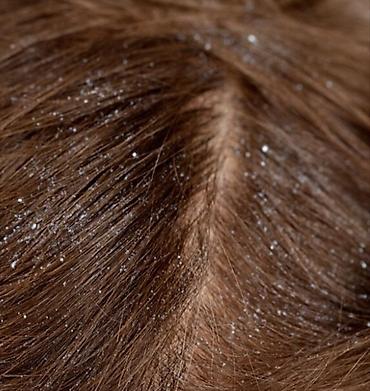 masaj yagi: Hello Hair Anti-Dandruff Shampoo – Golden Pearl • Məhsul növü: Kəpəyə — 3