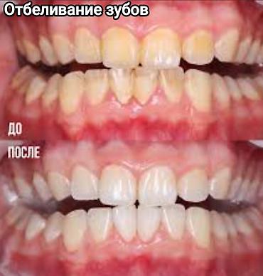 Стоматологи: Съёмные зубные протезы под ваши задачи - Вакуумные протезы: плотная — 9