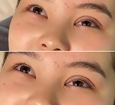 Косметология: Жип менен сурма чыгарабыз, операциясыз, кесилбейт, Оорубайт, шрам — 9