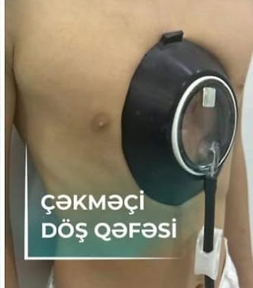 rf aparatı: Sinə batigi üçün vakuum aparatı.(Pektus)Qiymətdə razılaşmaq olar — 1