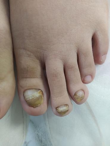 Маникюр: Коррекция вросших ногтей, Педикюр, Услуги подолога, Консультация, Одноразовые расходные материалы — 7