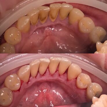 реставрация зуба: Стоматолог | Реставрация, Протезирование, Чистка зубов | Консультация, Круглосуточно