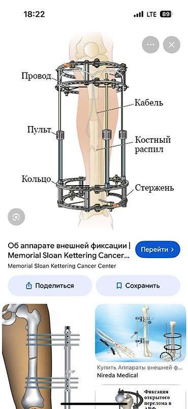 Медицинское оборудование: Аппарат внешней фиксации (комплектующие для сборки) Назначение: - — 1