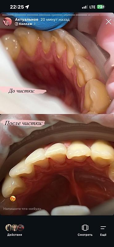 стоматологи: Профессиональная гигиена+отбеливание зубов=3800c - Комплекс услуг — 2