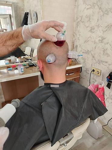 Hicama, zəli: HİCAMA EDİRƏM 30 AZN bankalar 1 dəfəlikdir sonra atilir 1 seansa 7 — 7