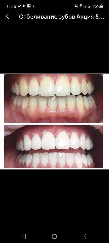 20 объявлений | lalafo.kg: Белоснежная улыбка 
Отбеливание зубов 
До/после 
Акция 5000 сом