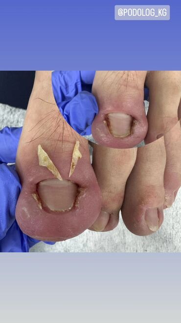 Маникюр, педикюр: Коррекция вросших ногтей, Педикюр, Услуги подолога, Консультация, Одноразовые расходные материалы — 14