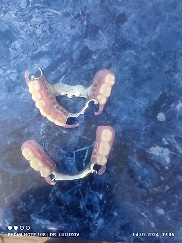 Ортезы: Съемные частичные зубные протезы - Тип: частичные протезы для верхней — 12