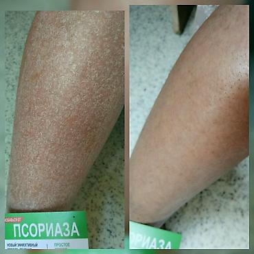 мазь cortam: Здравствуйте! Найден эффективный способ от Псориаза. Я сам болею этой — 10